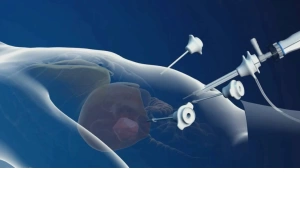 Endoskopik Prosedurlarda Təhlükəsizlik: Trokarların İstifadəsi