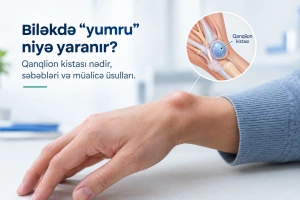 Biləkdə “yumru” niyə yaranır? Qanqlion kistası nədir, səbəbləri və müalicə üsulları