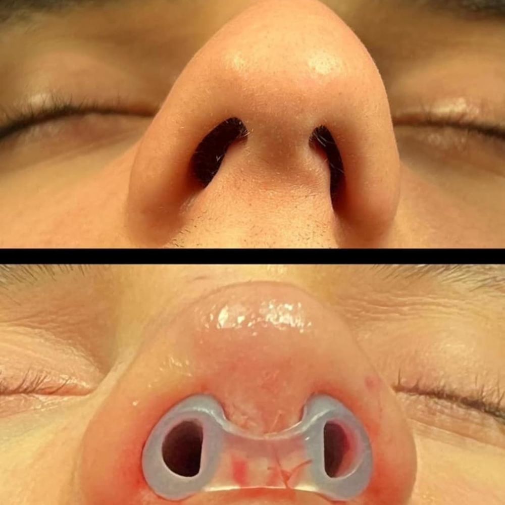 rinoplastika
