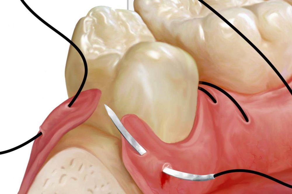 Yerləşdirilmiş implantların fiksasiyası